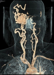 Imagem de tomografia demonstrando uma MAV- má formação arterio venosa.
